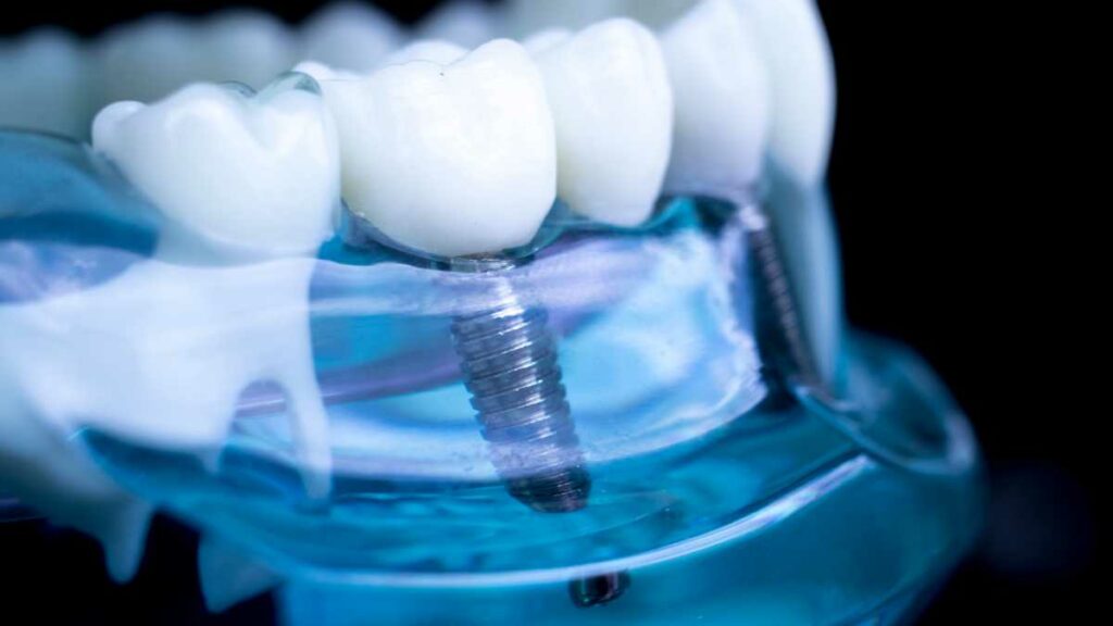 como apertar implante dentário